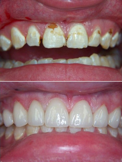 Patient's mouth before and after treatment