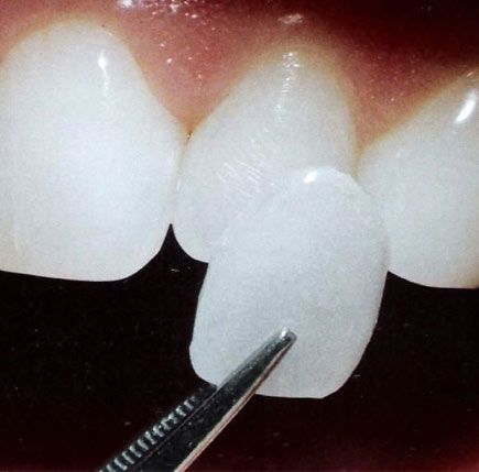 Macveneer
