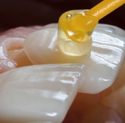 IPS e.max Veneers